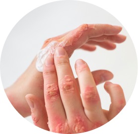 Psoriasis